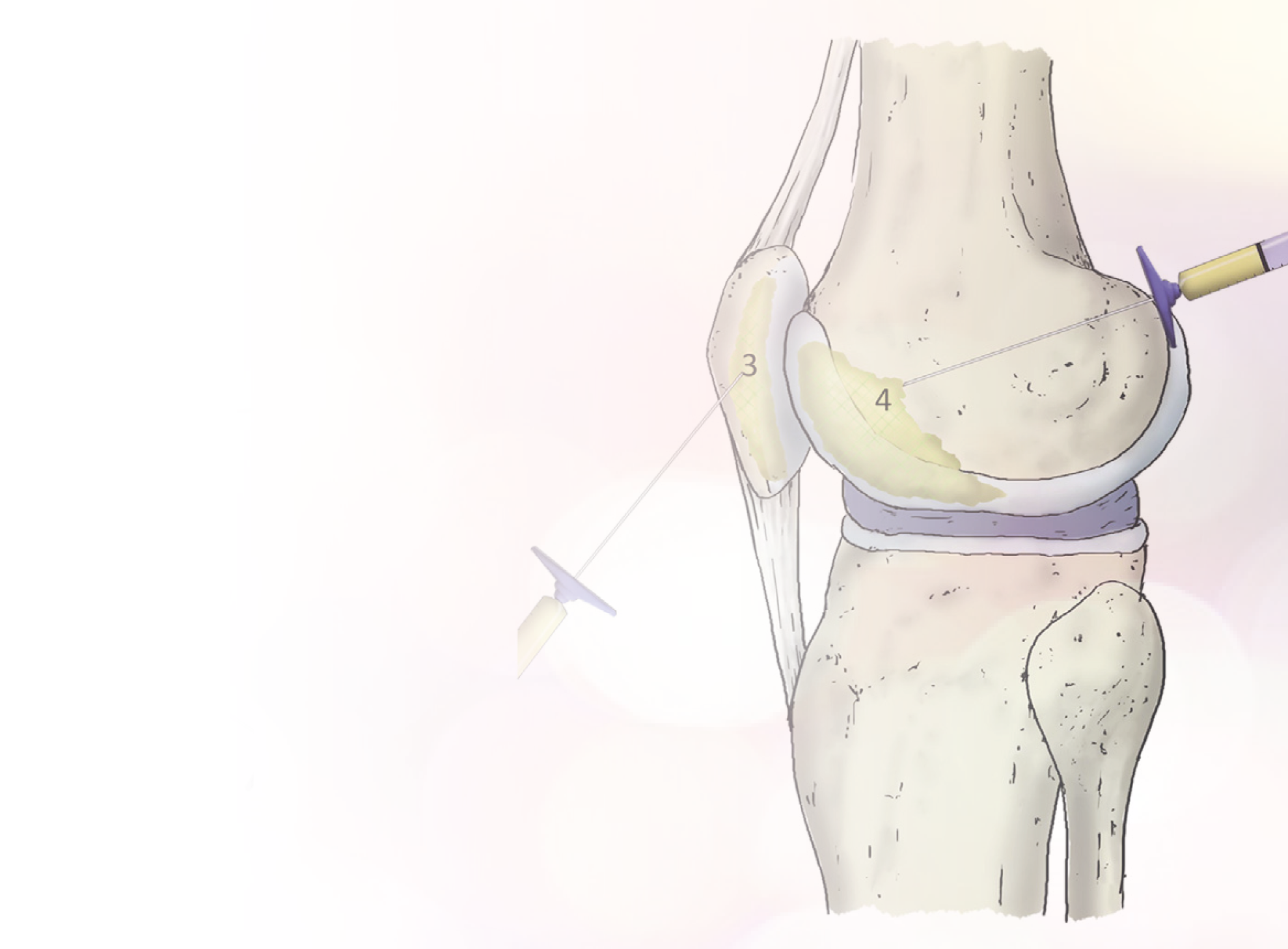 Intraosseous infiltration of platelet-rich plasma for severe knee osteoarthritis