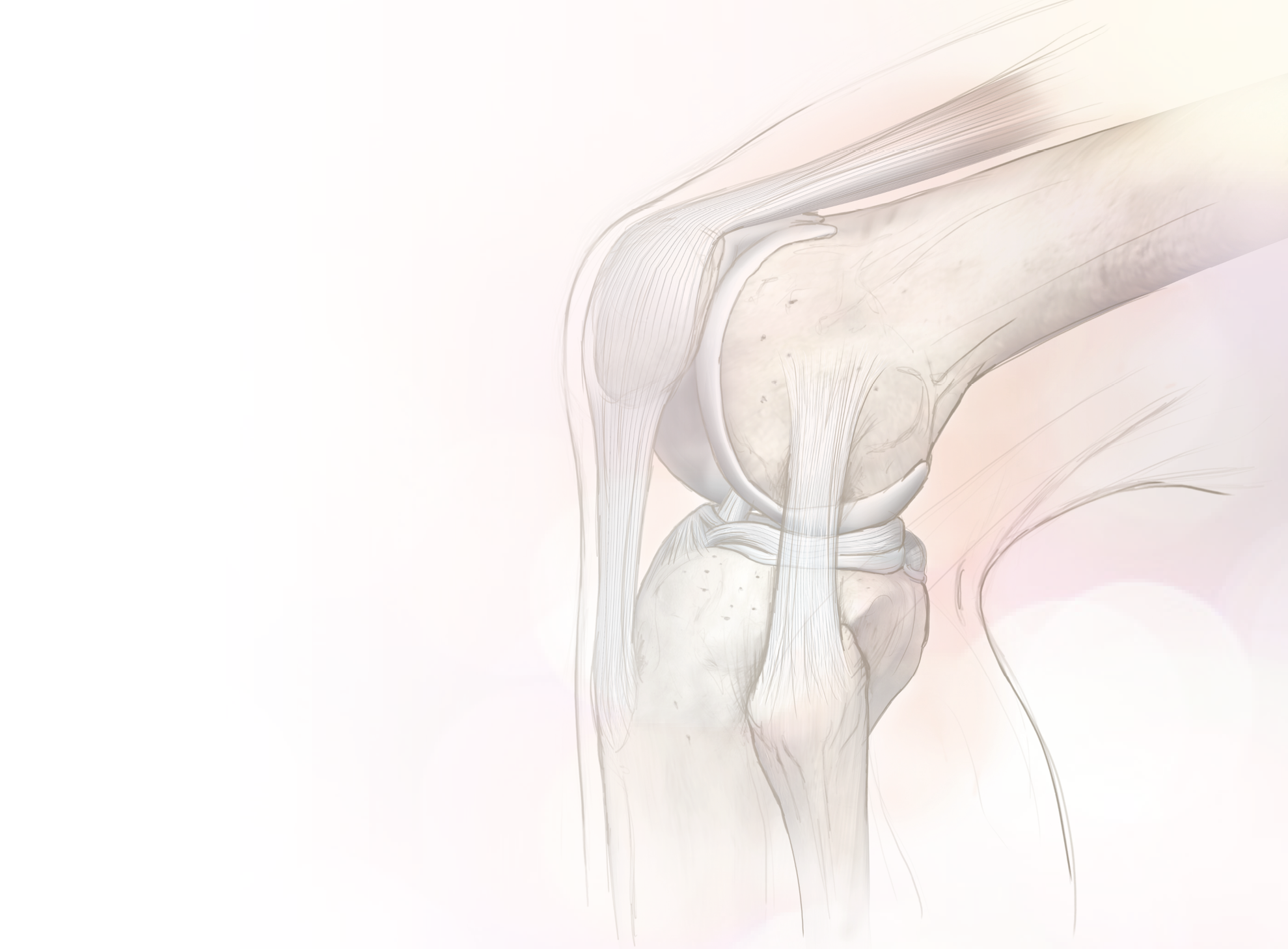 High survival rate after the combination of intrameniscal and intraarticular infiltrations of platelet-rich plasma as conservative treatment for meniscal lesions